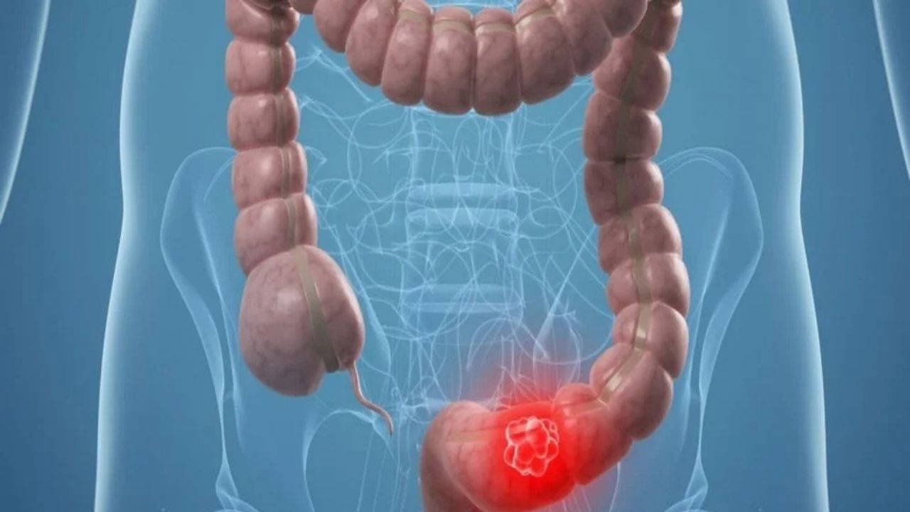 Uzmanından uyarı: İşlenmiş gıdalar erken yaşta bağırsak kanserine yol açabiliyor